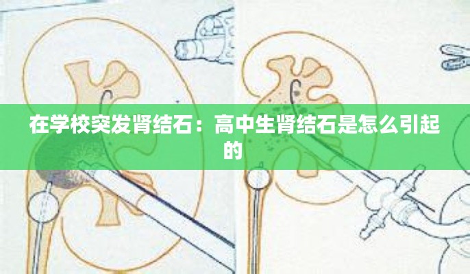 在学校突发肾结石：高中生肾结石是怎么引起的 