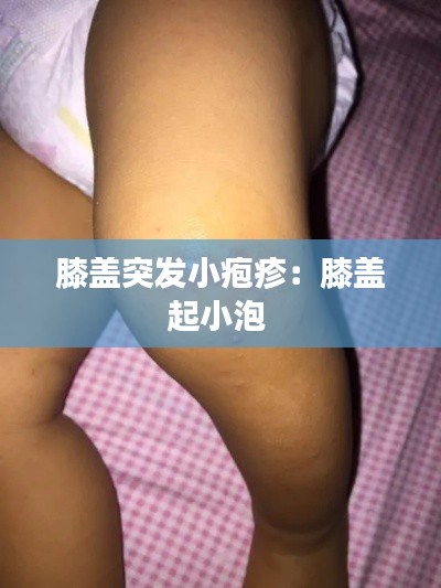 膝盖突发小疱疹：膝盖起小泡 