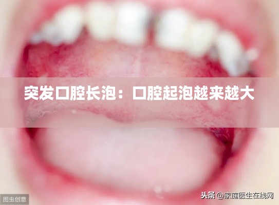 突发口腔长泡：口腔起泡越来越大 
