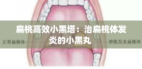扁桃高效小黑塔：治扁桃体发炎的小黑丸 
