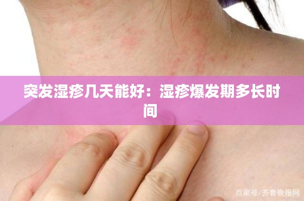 突发湿疹几天能好：湿疹爆发期多长时间 