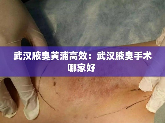 武汉腋臭黄浦高效：武汉腋臭手术哪家好 