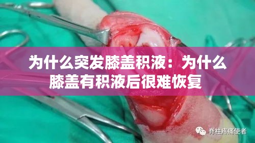 为什么突发膝盖积液：为什么膝盖有积液后很难恢复 