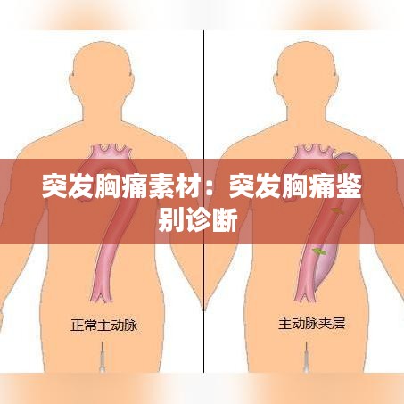 突发胸痛素材：突发胸痛鉴别诊断 