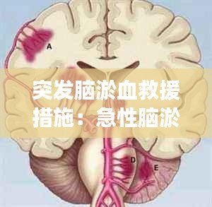 突发脑淤血救援措施：急性脑淤血抢救生还率 