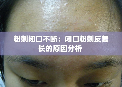 粉刺闭口不断：闭口粉刺反复长的原因分析 