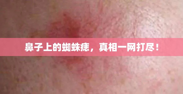 鼻子上的蜘蛛痣，真相一网打尽！